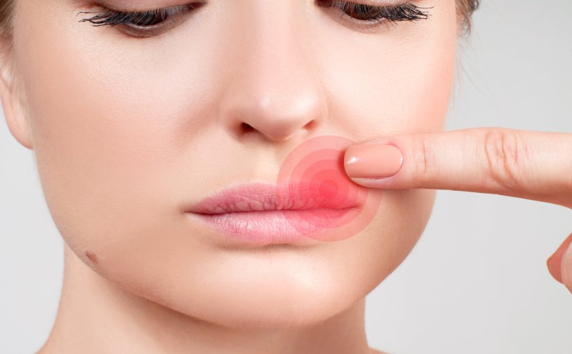 Managing Cold Sores: Exploring Treatment&nbsp;Options