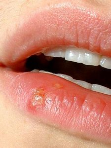 Cold sores, cause and&nbsp;stigma.